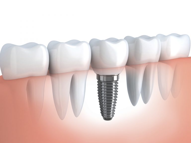 dental-implants-canarsie