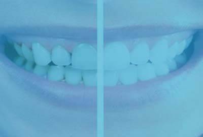 teeth whitening dentist 